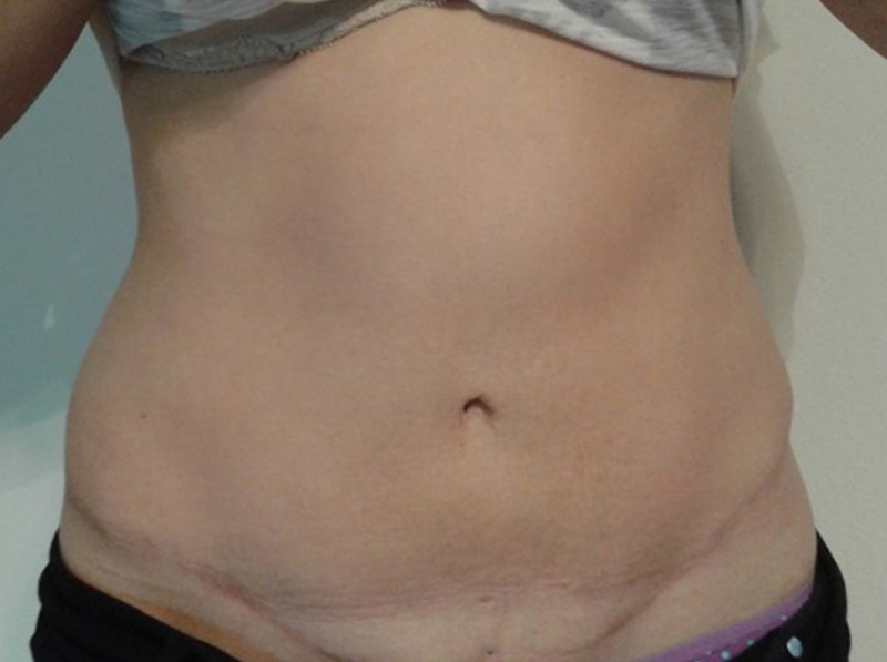 Results BEFORE & AFTER - Abdominoplasty - Mom Makeover® - Δρ. Νίκος Ναούμ